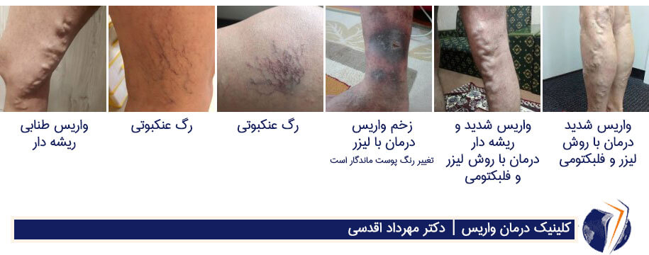 چند تصویر از انواع واریس + درمان واریس پا