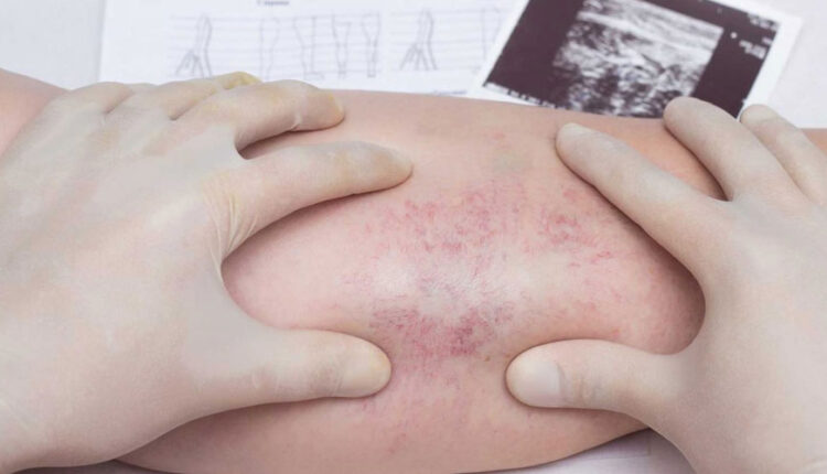 همه چیز درباره ی ترومبوفلبیت سطحی