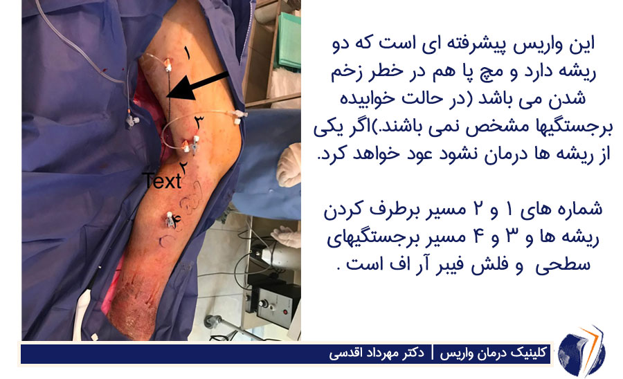 واریس پیشرفته دو ریشه ای در حال درمان