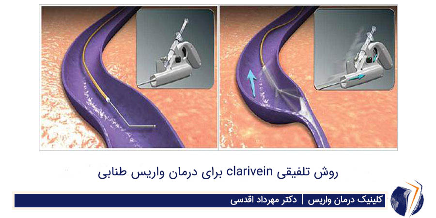 روش تلفیقی clarivein برای درمان واریس طنابی