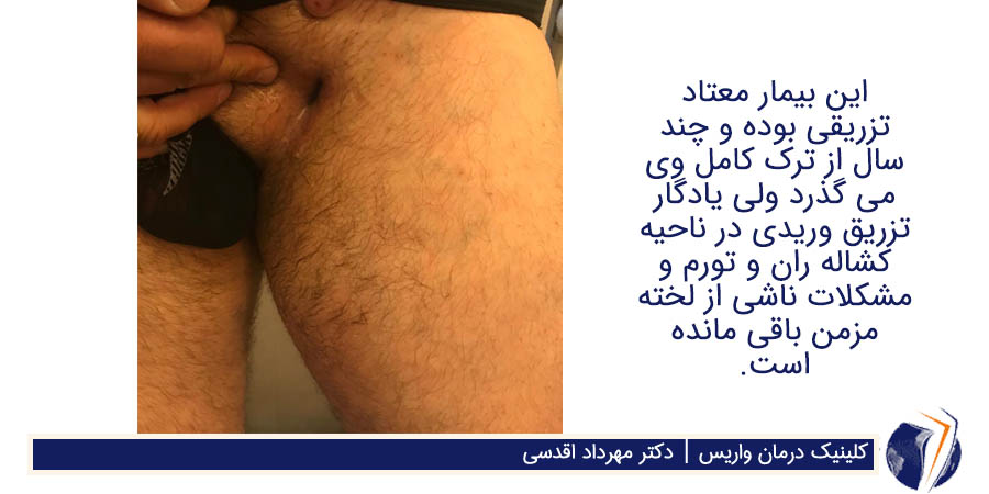 تزریق وریدی در ناحیه کشاله ران