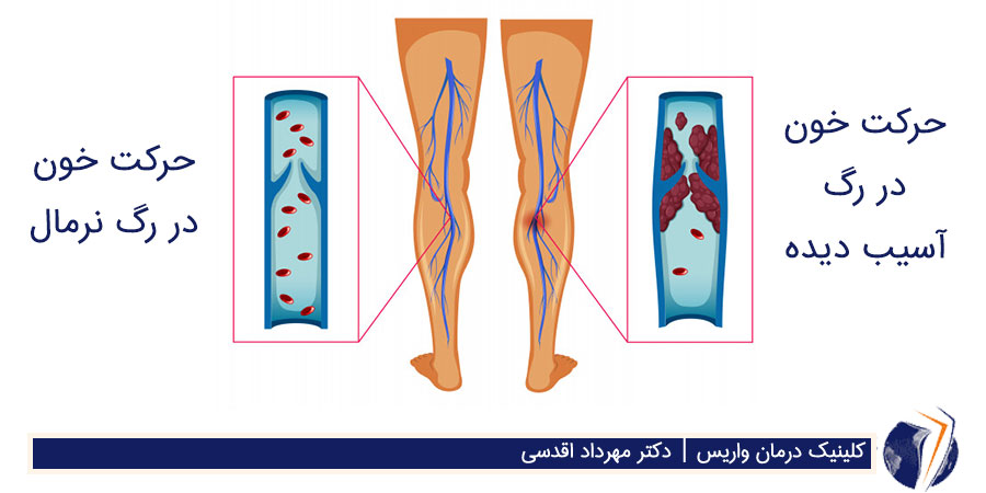 خون لخته شده در جدار رگ آسیب دیده و حرکت نرمال خون در رگ سالم و طبیعی
