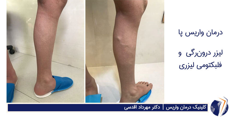 قبل و بعد رمان واریس