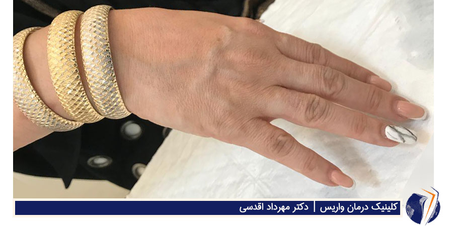 دستی که به علت رگ های واریسی پیر به نظر می رسد