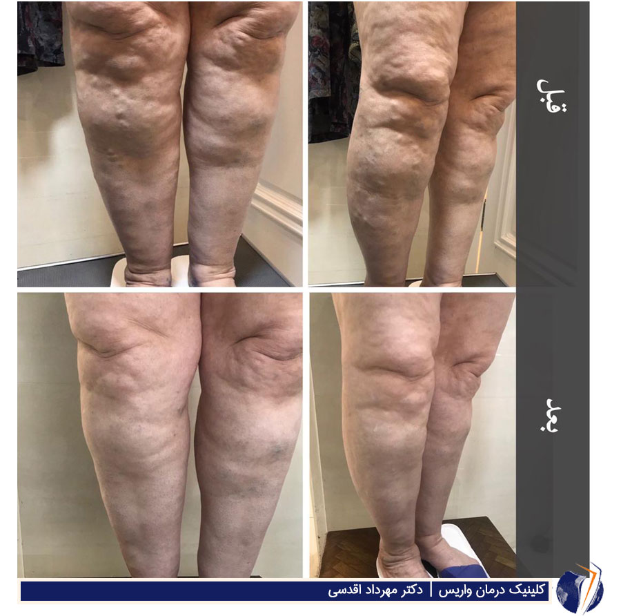 روش جدید و ابداعی دکتر اقدسی برای درمان واریس طنابی