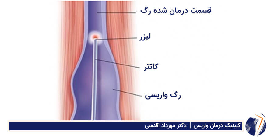 لیزر واریس در تهران