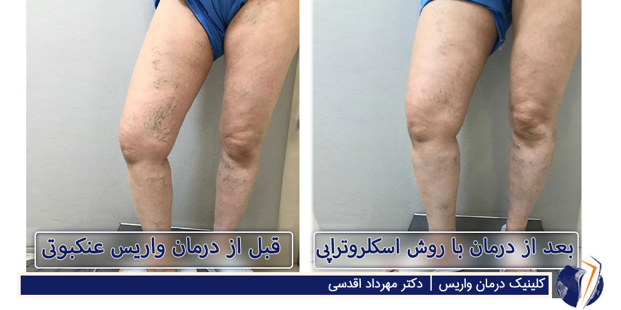 عکس قبل و بعد از درمان رگ‌های عنکبوتی پاها با روش اسکلروتراپی