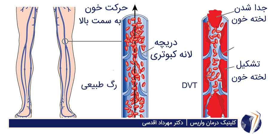 تشکیل لخته خون در بارداری