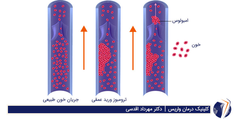 ترومبوز وریدی