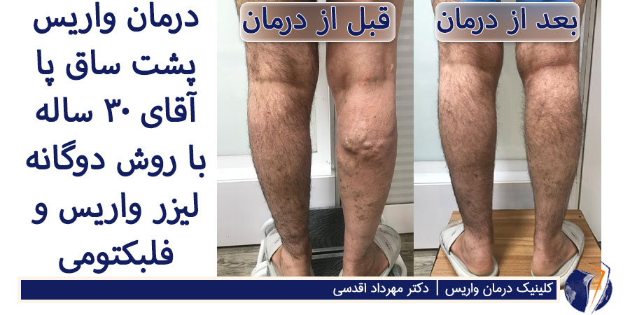 عکس قبل و بعد از درمان واریس طنابی پشت ساق پا مرد جوان