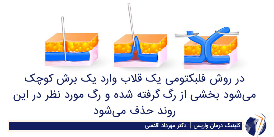 فلبکتومی برای از بین بردن واریس پا