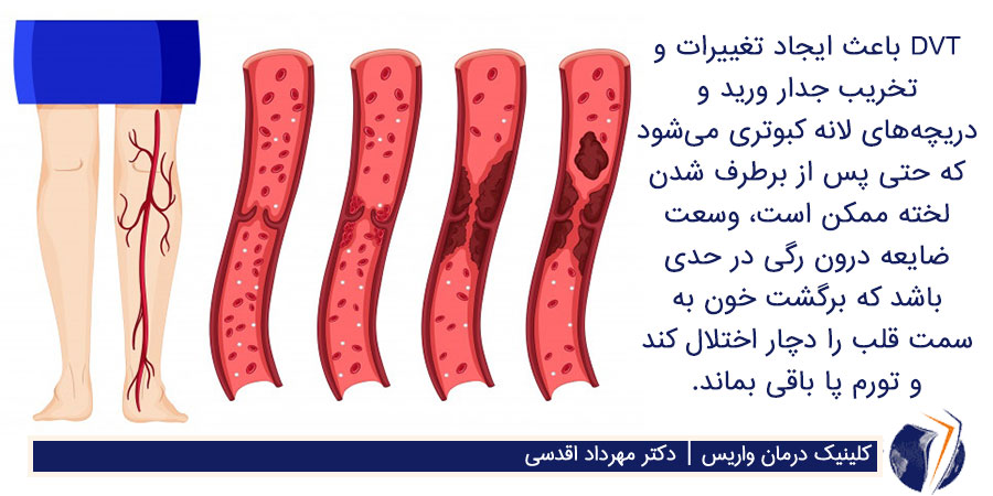 نقش بیماریdvt بر سلامت عروق و بسته شدن جداره های داخلی رگ که در نتیجه هنوز پا متورم است