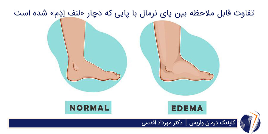 مقایسه دو پا که یکی بر اثر ادم متورم است و پای دیگر ظاهری نرمال دارد