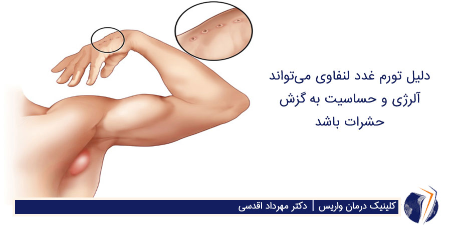 تورم غده لنفاوی زیر بغل در نتیجه گزش روی دست و حساسیت و آلرژی