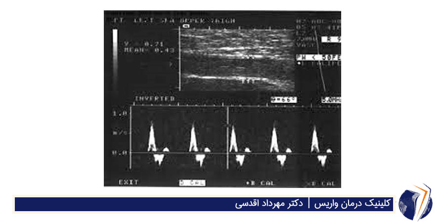 سونوگرافی داپلکس