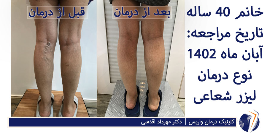 عکس قبل و بعد از درمان واریس برجسته پشت زانو با لیزر شعاعی