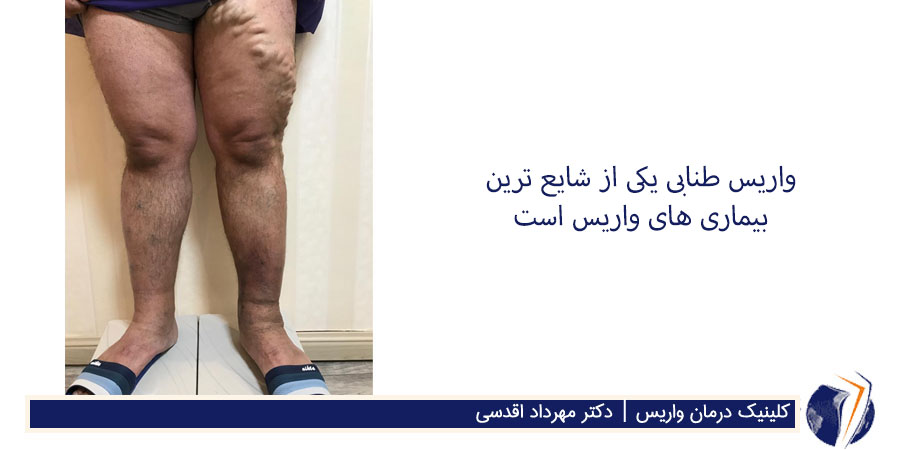 بیماری واریس طنابی