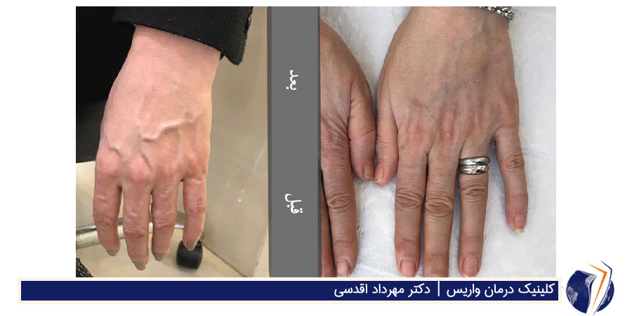 قبل و بعد از درمان واریس دست