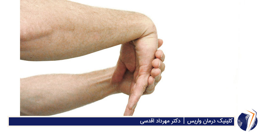 کشش مچ برای درمان وریس دست