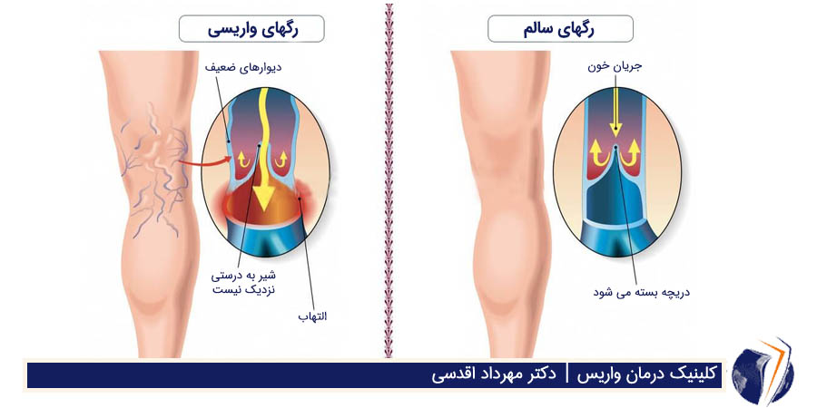 رگهای واریسی ، رگهای سالم