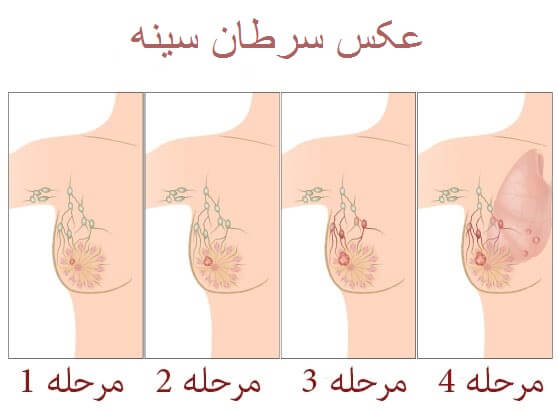 تغییرات سینه هنگام سرطان