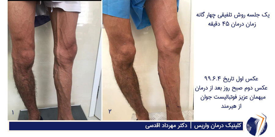 نمونه کار دکتر اقدسی با روش تلفیقی درمان واریس