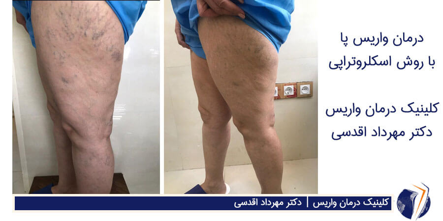 عکس واریس برای درمان با روش فلبکتومی