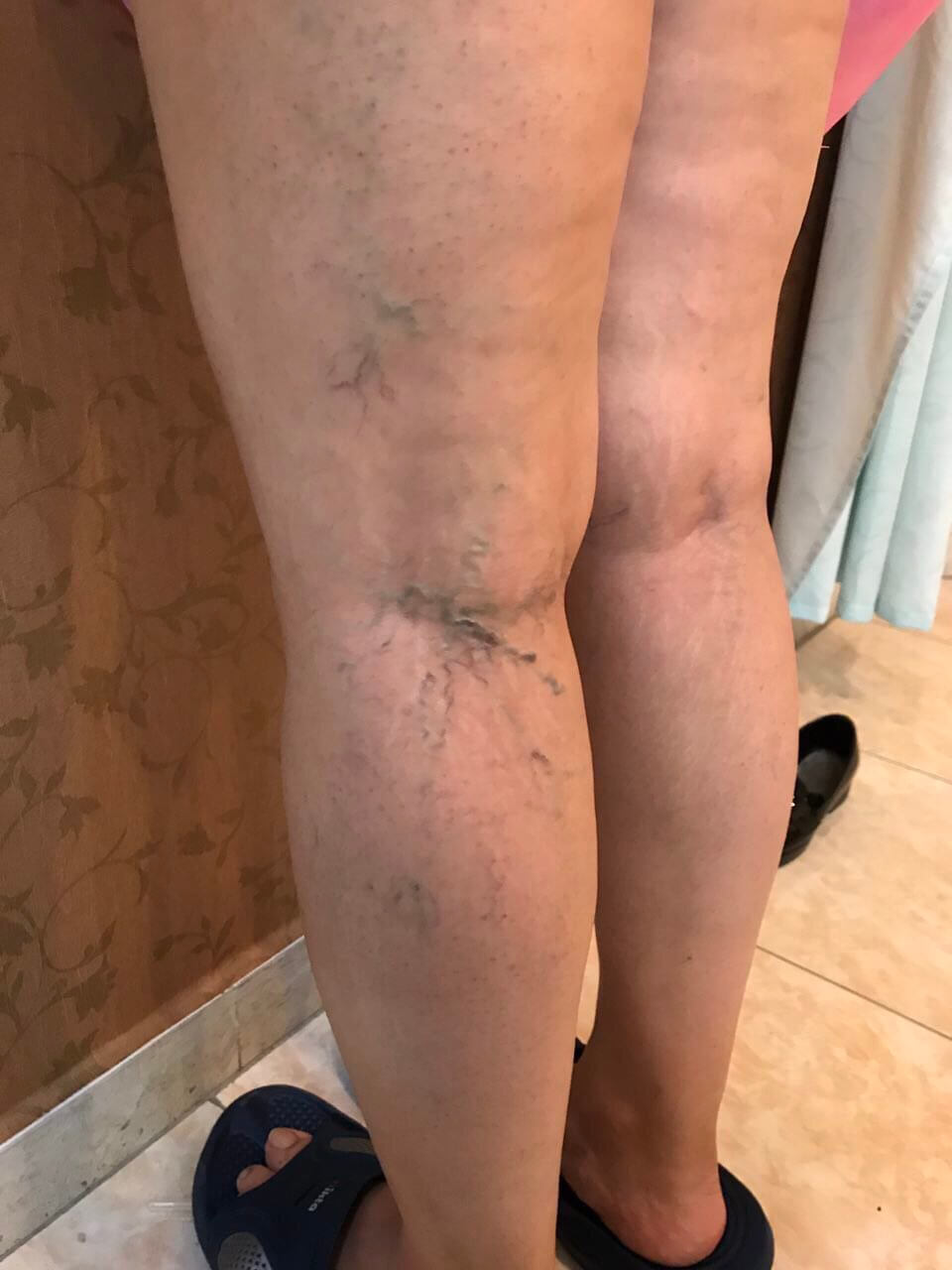 عکس واریس قبل و بعد درمان با روش چهارگانه