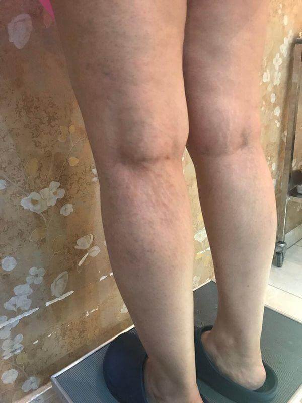 یک جلسه تلفیقی لیزر سطحی عروق عنکبوتی و تزریق