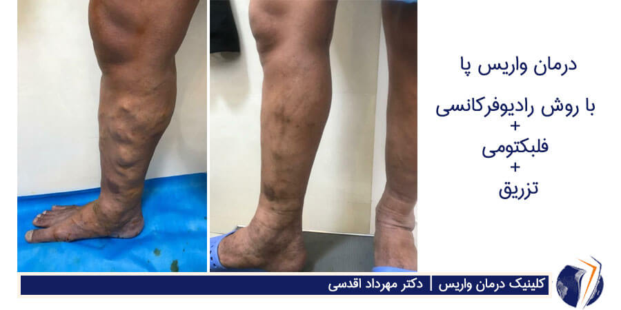 عکس واریس جهت درمان با روش رادیوفرکانسی + فلبکتومی +تزریق