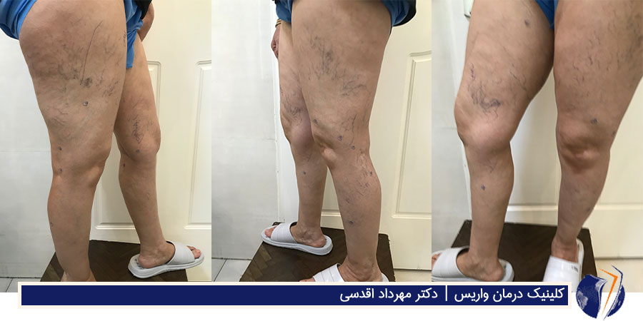 واریس عنکبوتی و خوشه‌ای ران و ساق پای خانم جوان قبل از درمان
