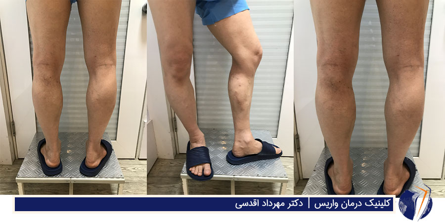 عکس بعد از درمان واریس برجسته طنابی ساق پا مرد 41 ساله