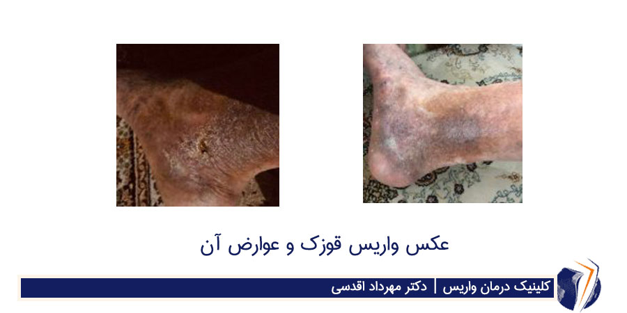 عکس قبل و بعد از درمان واریس قوزک پا