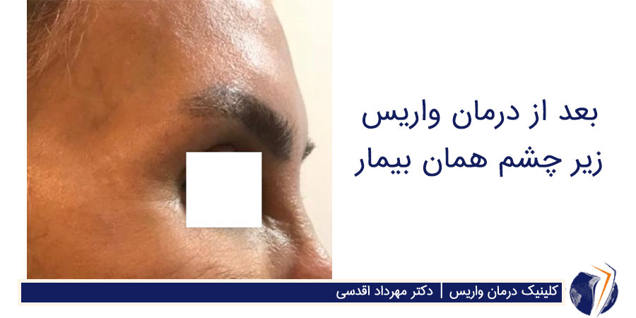 عکس بعد از درمان رگ‌های زیر چشم و پیشانی خانم میانسال