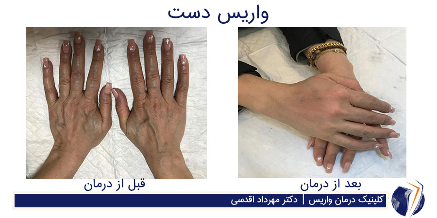 عکس دست زن قبل از درمان واریس دست که رگها متورم برجسته و سبز هستند و بعد از درمان واریس دست که اثری از رگهای سبز و ملتهب نیست