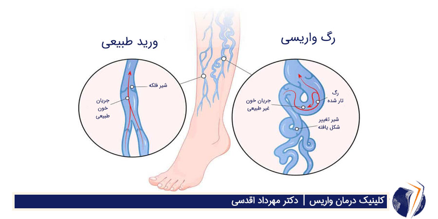 رگ واریسی ، ورید طبیعی