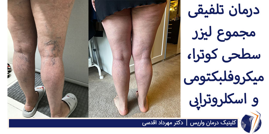 عکس قبل و بعد از درمان واریس عنکبوتی پشت زانو وران پا به روش تلفیقی پروفسور اقدسی