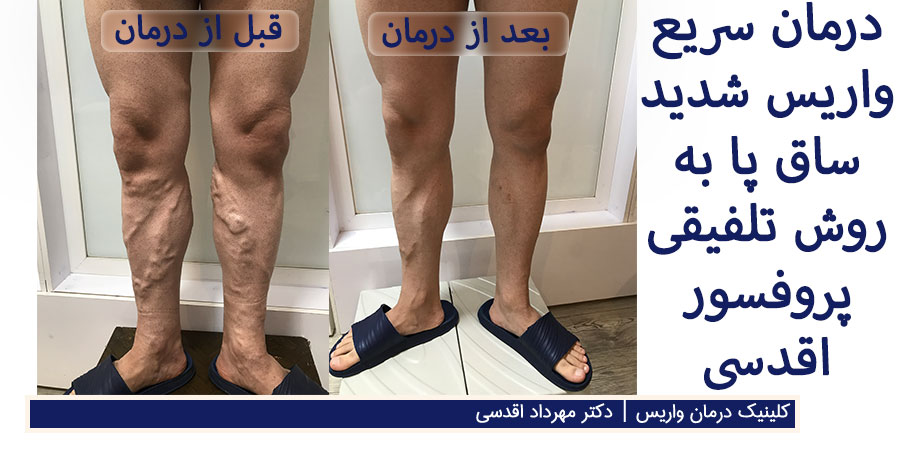 عکس قبل و بعد از درمان سریع واریس شدید و برجسته ساق پا با روش پروفسور اقدسی