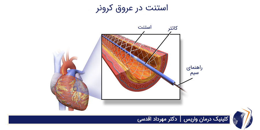 استنت در عروق کرنر