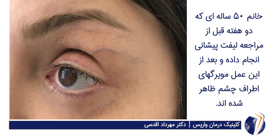 خانم ۵۰ ساله ای که دو هفته قبل از مراجعه لیفت پیشانی انجام داده و بعد از این عمل مویرگهای اطراف چشم ظاهر شده اند.