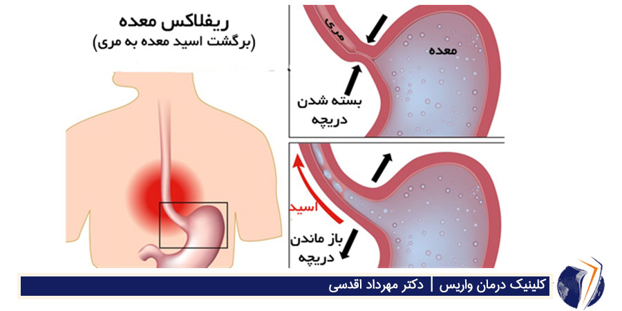 بیماری رفلاکس معده یا مری