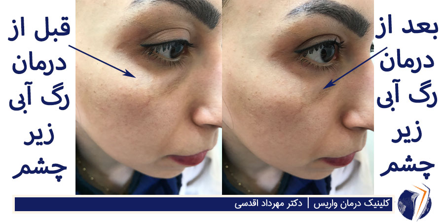 عکس قبل و بعد از درمان رگ آبی زیر چشم خانم جوان