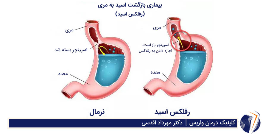 رفلاکس معده