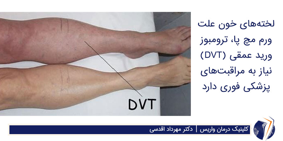 علت درد و ورم در مچ پاها