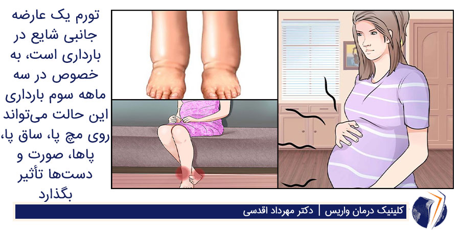 علت ورم پاها در بارداری
