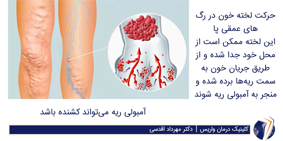 حرکت لخته خون در پا و به سمت قسمت بالا تنه میتواند منجر به آمبولی ریه شود و کشنده باشد