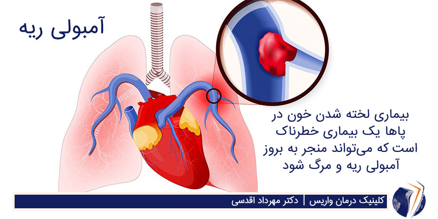 لخته خون در بافت ریه و در نتیجه امبولی ریه