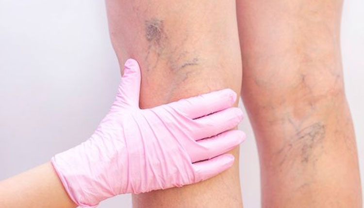 Cryo Laser & Cryo Sclerotherapy