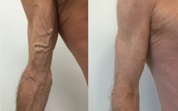 واریس روی بازو بر اثر افزایش سن و لاغری عکس قبل و بعد از درمان