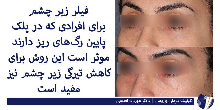 درمان رگ‌های آبی زیر چشم